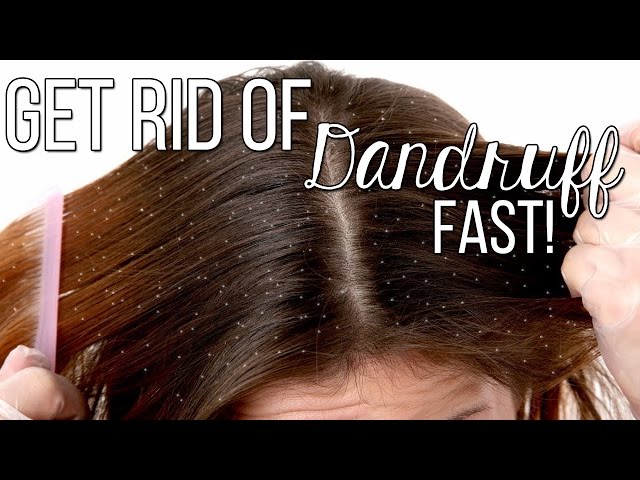 How to get rid of Dandruff FAST!! Only 2 Ingredients! Highly effective!