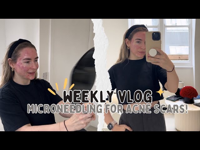 MICRONEEDLING FOR ACNE SCARS + DECLUTTERING | Weekly Vlog