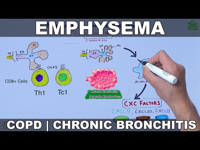 Emphysema | COPD