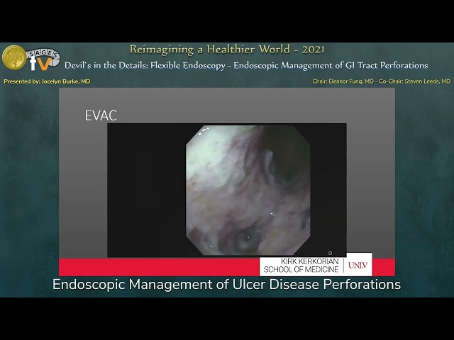 Endoscopic Management of Ulcer Disease Perforations