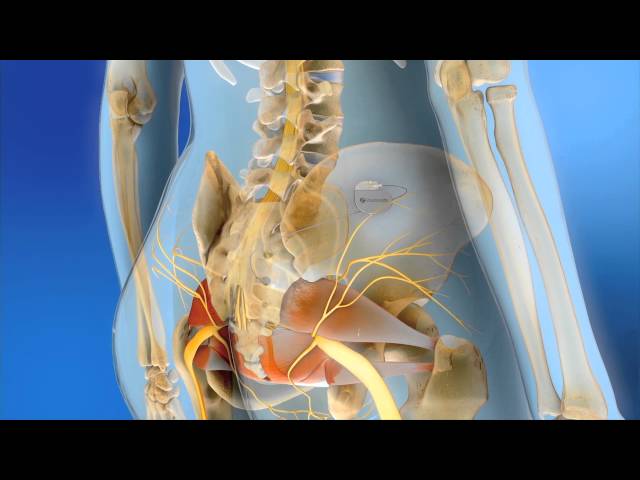 Sacral Neuromodulation | MOA Animation