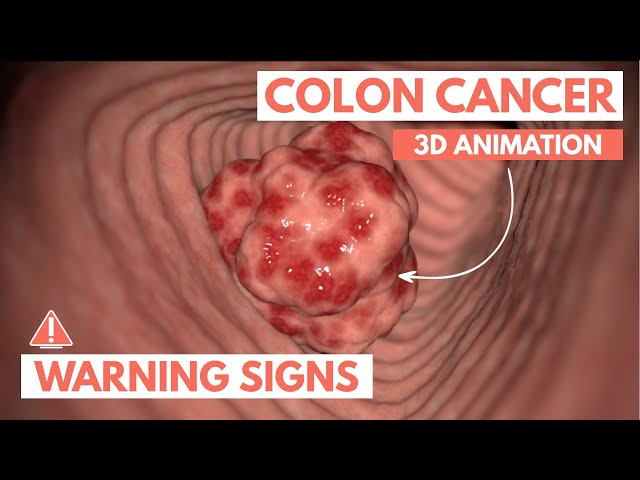 5 warning signs of Colon Cancer | 3D Animation
