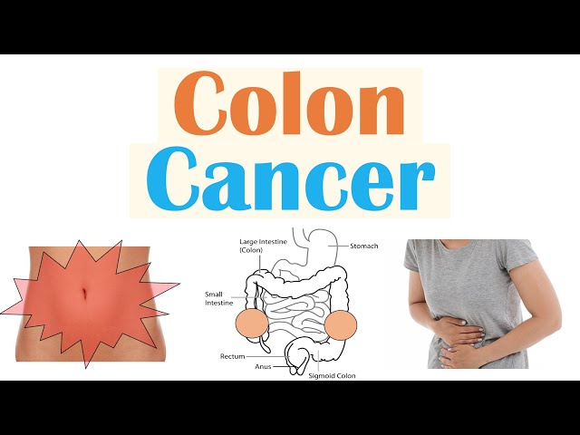 Colon Cancer (CRC) Risk Factors, Pathogenesis, Symptoms, Diagnosis, Staging, Treatment