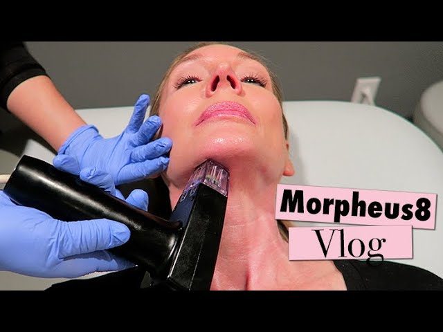 Morpheus8 Neck Treatment & Recovery Vlog!