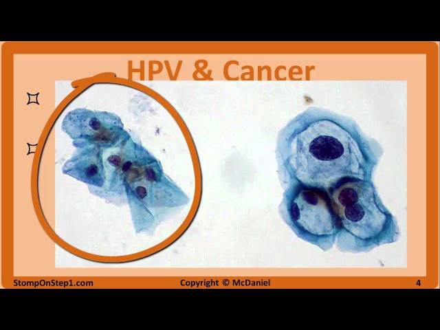 HPV, Parvovirus B19 & Adenovirus: Cervical Cancer, Fifths Disease, Warts, Slapped cheek, Koilocyte