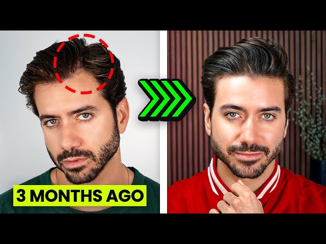 Everything I'm doing to stop balding (thinning hair)