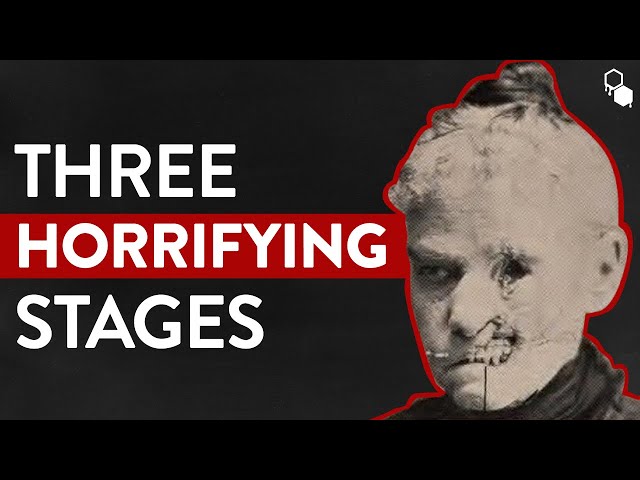 The Three Horrifying Stages of Syphilis