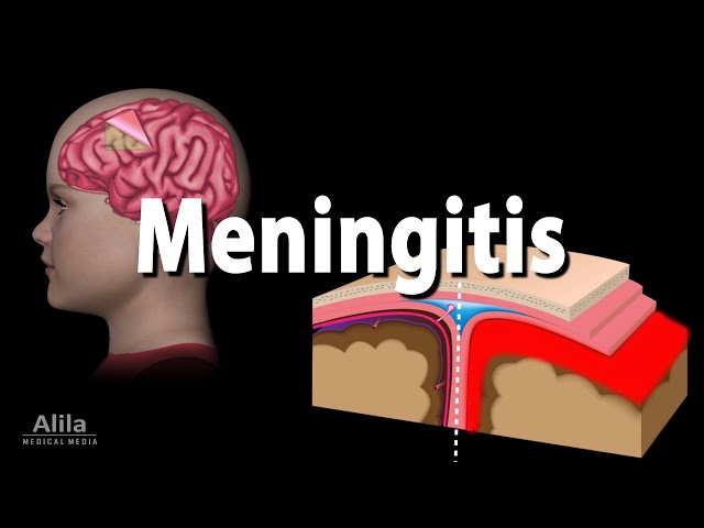 Meningitis: Pathology, Causes, Symptoms, Diagnosis and Treatment, Animation