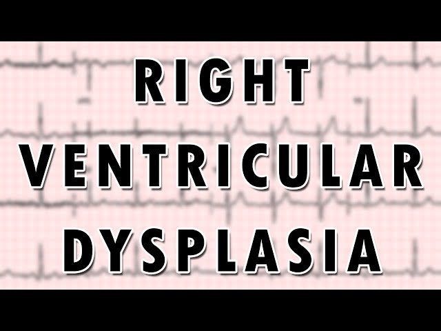 Right Ventricular Dysplasia