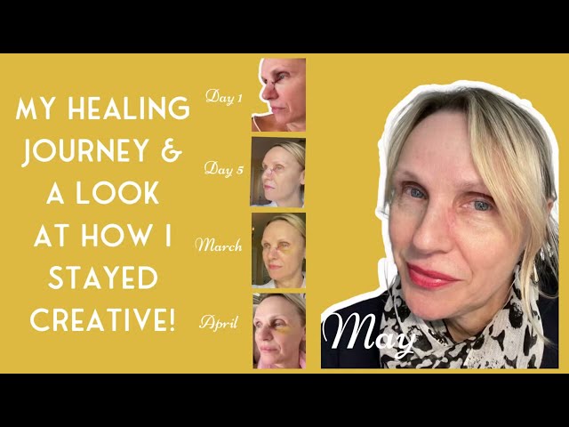 Basal Cell Carcinoma Update and How Staying Creative Was Key.