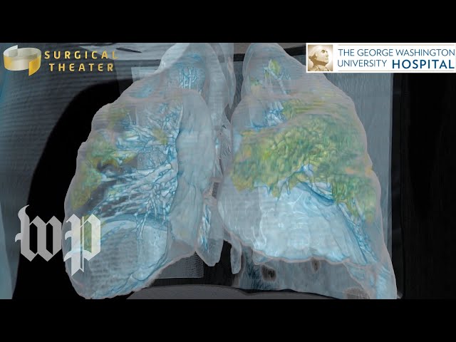 CT scan shows damaged tissue from a covid-19 patient's lungs