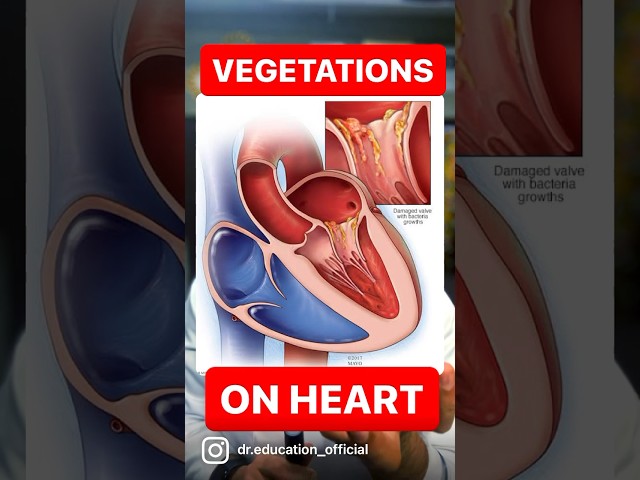 Vegetations on mitral valve infective endocarditis #endocarditis  #heart #short