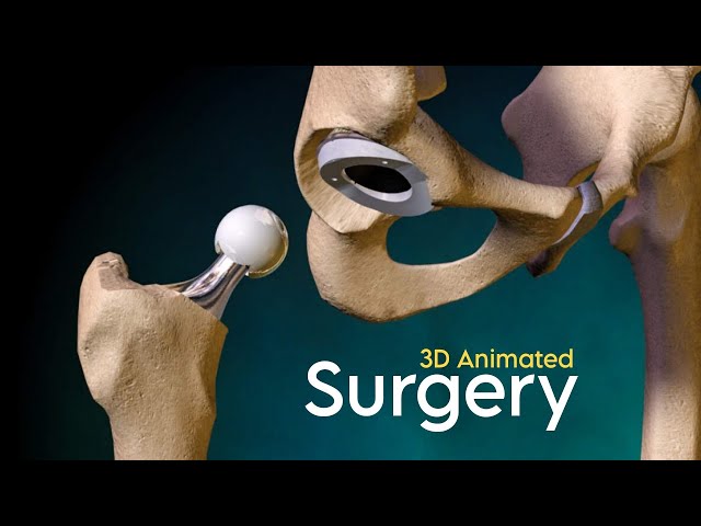 Total Hip Replacement Surgery (3D Animation)  | 5 Types |