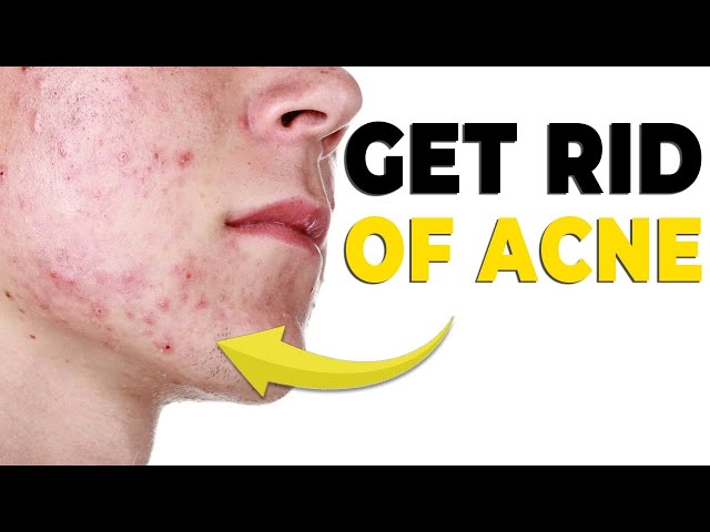 5 Skin Imperfections you can fix FAST & OVERNIGHT *no more acne*