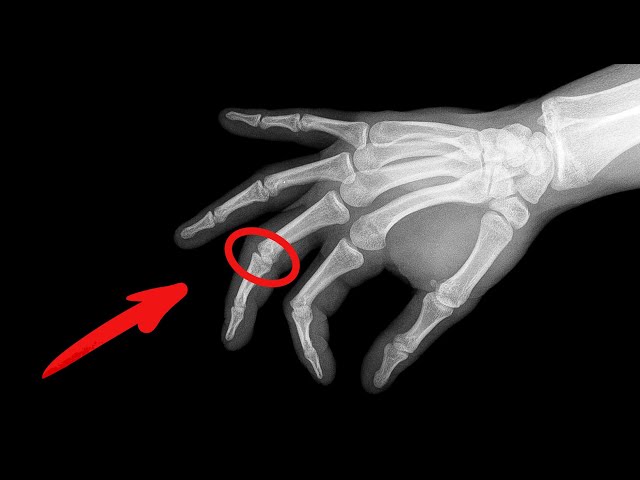 Why a man cracked the knuckles of his left hand for 50 years
