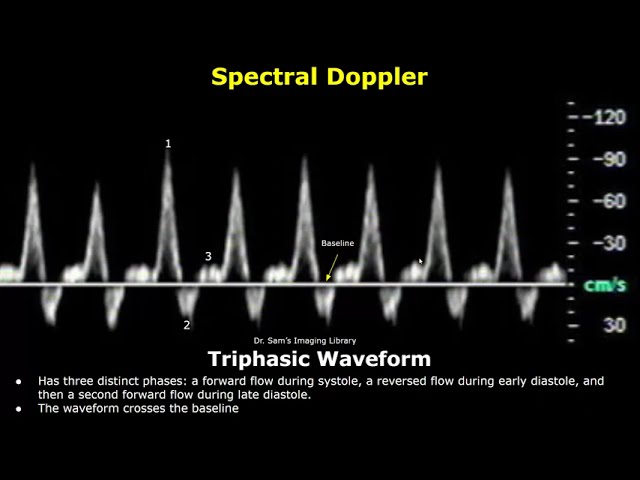 Monophasic, Biphasic & Triphasic Spectral Doppler Waveforms | Vascular Ultrasound Analysis (USG)