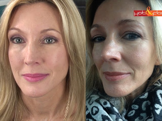 My Experience With Botox & Filler (Juvederm)