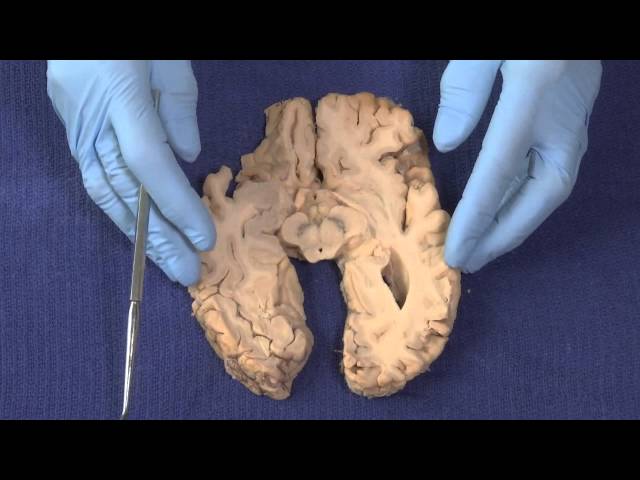 Basal Ganglia: Neuroanatomy Video Lab - Brain Dissections