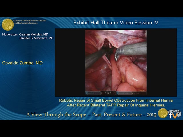 Robotic Repair of Small Bowel Obstruction From Internal Hernia After...
