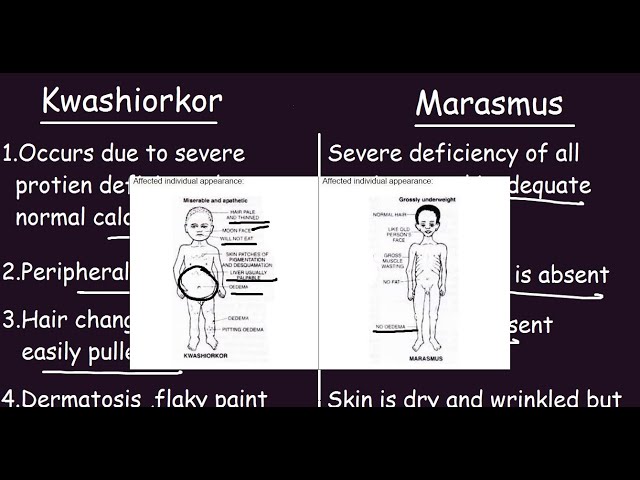 Kwashiorkor vs Marasmus |Quick Differences & Comparison|