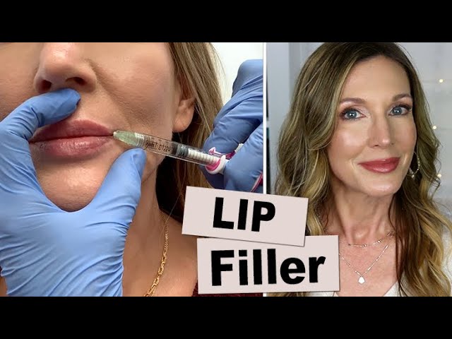 My Experience Getting Lip Filler for Vertical Wrinkles!