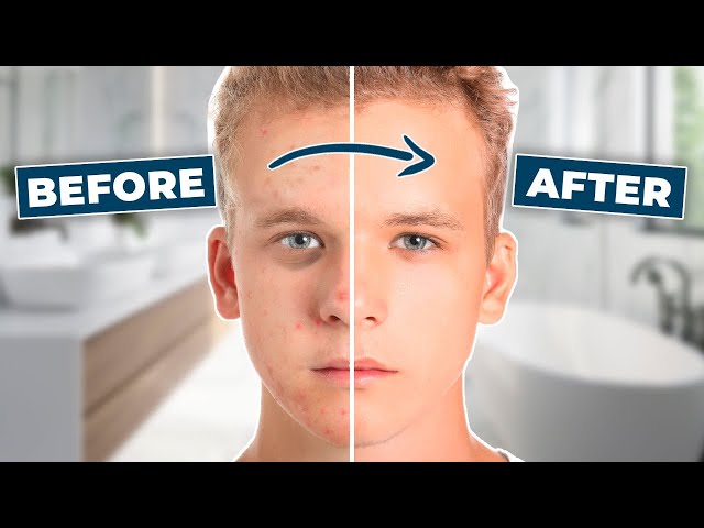 TEEN ACNE? STOP DOING THESE 5 THINGS! l Alex Costa