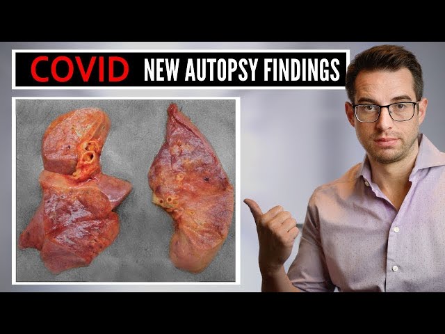 What Doctors Are Learning From Autopsy Findings of COVID Patients