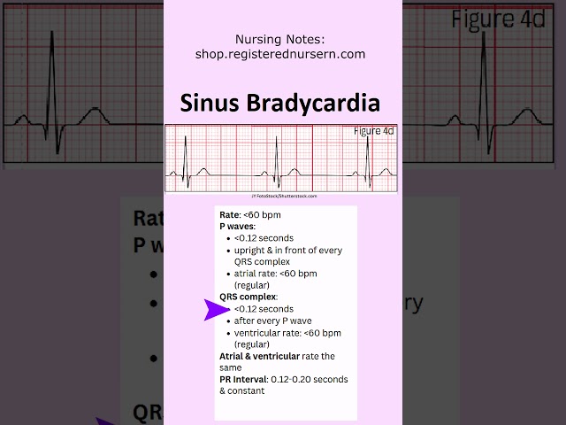 Sinus Bradycardia ECG EKG Nursing: Treatment, Rhythm Made Easy in Less Than 1 Minutes #nursing #ecg