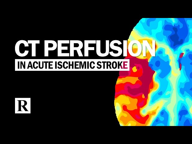 CT Perfusion In Acute Ischemic Stroke
