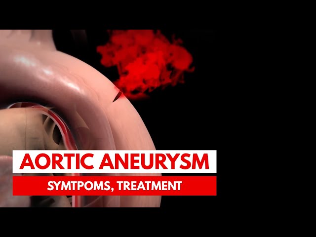 What is an Aortic Aneurysm? | 3D Animation