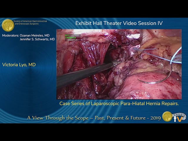 Case Series of Laparoscopic Para-Hiatal Hernia Repairs