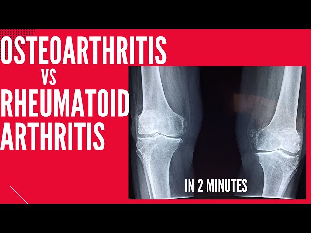 Osteoarthritis vs Rheumatoid arthritis in 2 mins!