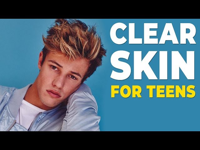 How To GET RID OF ACNE for Teens | Clear Skin FAST 2020 | Alex Costa