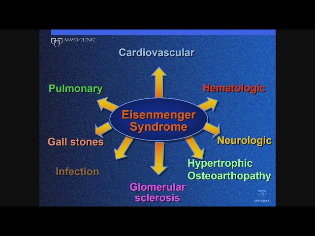 Adult Congenital Heart Disease: Eisenmenger Syndrome
