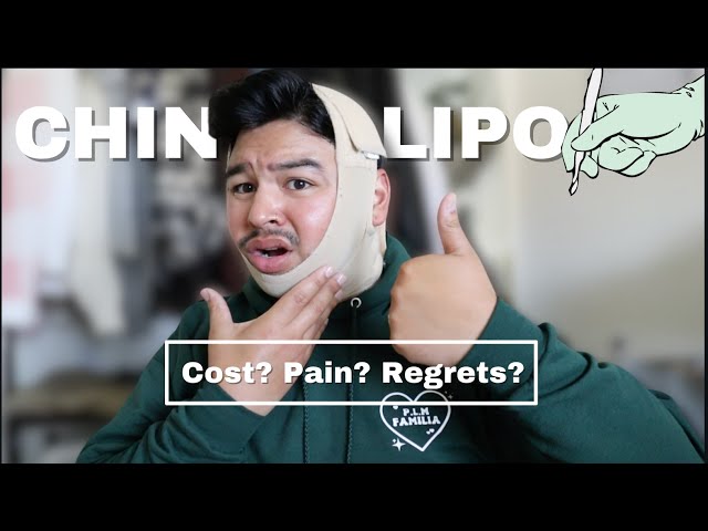 Chin Liposuctions (My Experience, Pain, Cost, Regrets?) | alantimoteov
