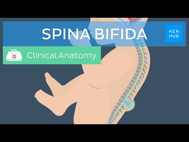 Spina bifida: Causes, classification, prevention and treatment | Kenhub