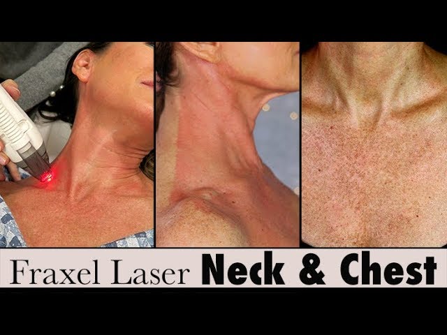 Fraxel Laser Treatment for Sun Damage Chest + Neck   Before + After