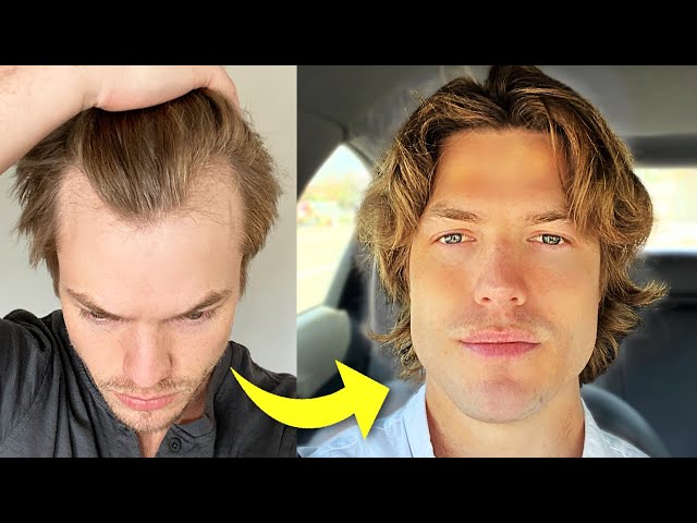 My Turkey Hair Transplant Results After 1 Year | Before & After