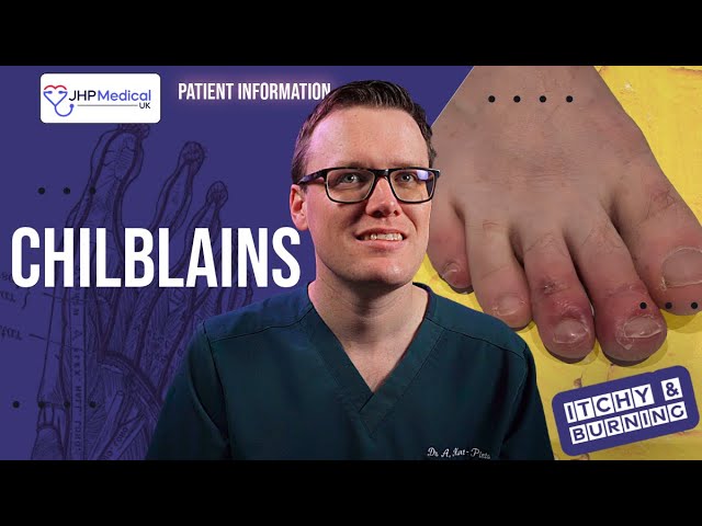 How To Get Rid Of CHILBLAINS (Pernio): Itchy Sores On Your Fingers And Toes - Doctor Explains