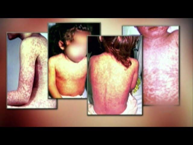 Doctors urge people to get vaccinated as measles cases grow