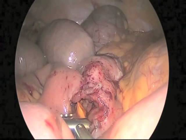 The Laparoscopic Approach to Small Bowel Obstruction