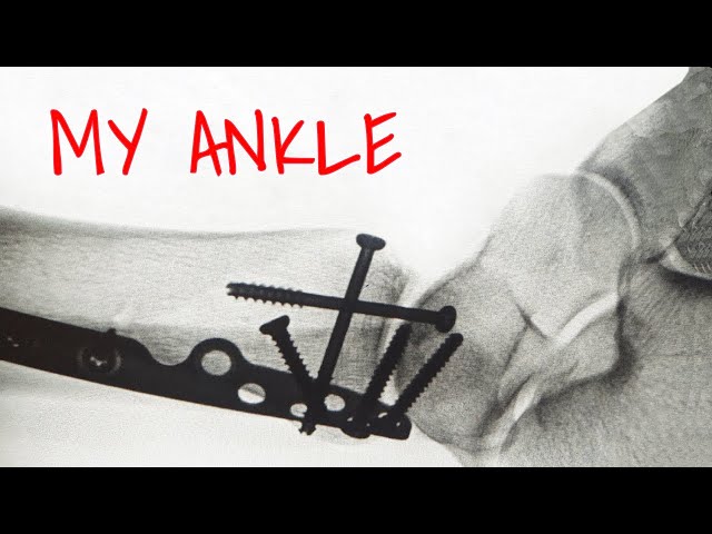 How I Broke My Ankle Kiteboarding - VLOG #50