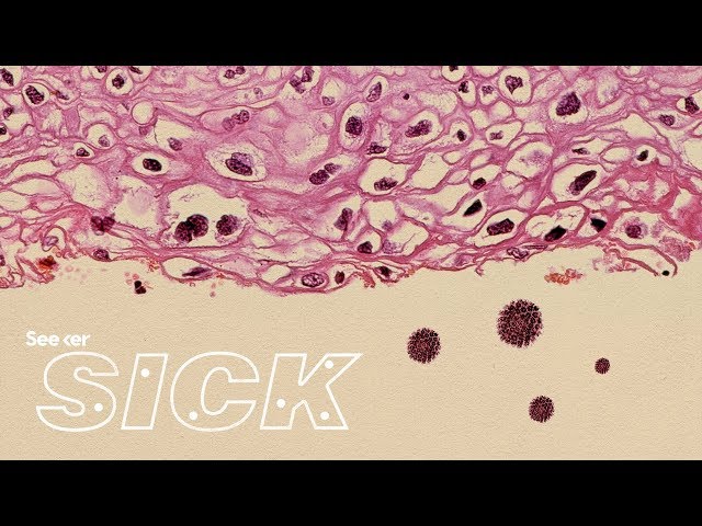 This Is How HPV Causes Cancer