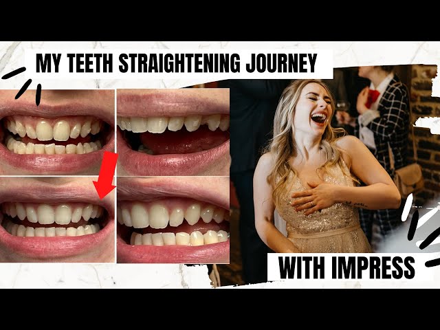 My Teeth Straightening Journey with Impress | Invisible Aligners Honest