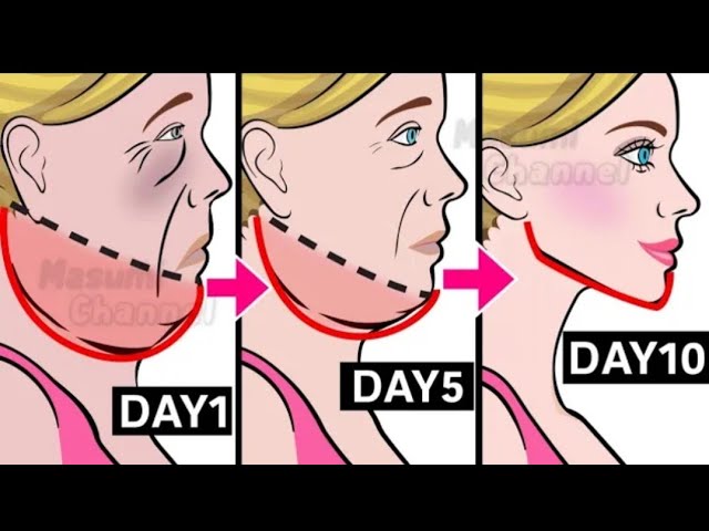 Fast Results! Jaw angulation in one month