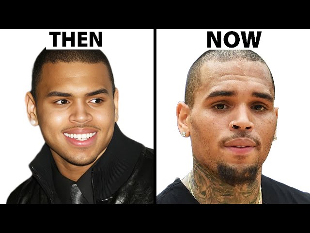 Did Chris Brown Have Plastic Surgery? | Plastic Surgery Analysis
