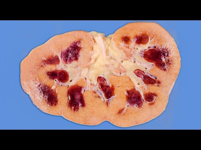 A Boy Ate 25 Laxative Brownies In 1 Hour. This Is What Happened To His Kidneys.