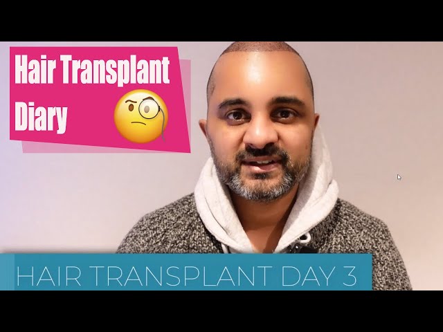 HAIR TRANSPLANT UK |  DAY 3-4 - PART 4 #hairtransformation #hairtransplant #fue #transplant