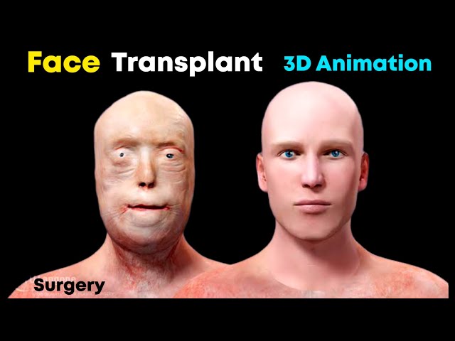 Face Transplant (Surgery) 3D Animation