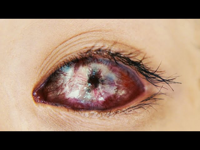 She Slept With Her Contacts In, This Is What Happened To Her Eyes